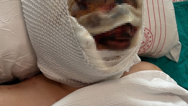 Eski eşi tarafından vahşete uğrayan kadın o anları anlattı, acılı baba sert tepki gösterdi
Ağır yaralı S.Ç: "Yüzüme bir şey döktü, kafamın üzerine bir şey döktü, sonrasında da ben bayıldım"
Baba C.Ç: "Kızımın başından asit dökmüş, kızımı mahvetmiş"
Gaziantep'te vahşet: Eski eşini kezzapla ağır yaraladı
Ağır yaralı kadın hasta yatağında o anları anlattı