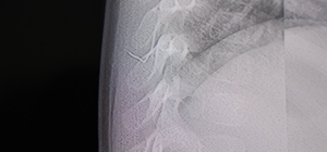 Bebeğin sırtından tel parçası çıktı