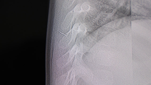 Bebeğin sırtından tel parçası çıktı