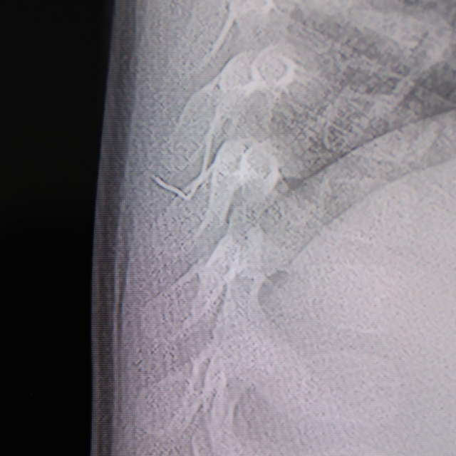 Bebeğin sırtından tel parçası çıktı