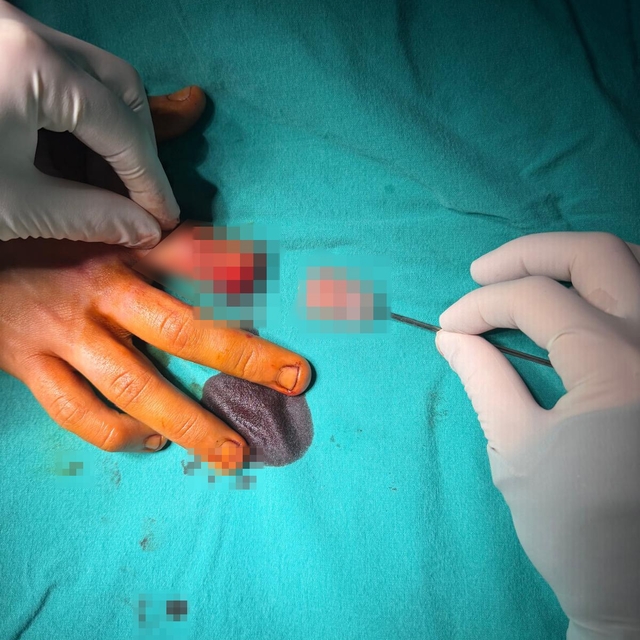 Bandırma'da asansör kazasında kopan parmak başarılı ameliyatla kurtarıldı