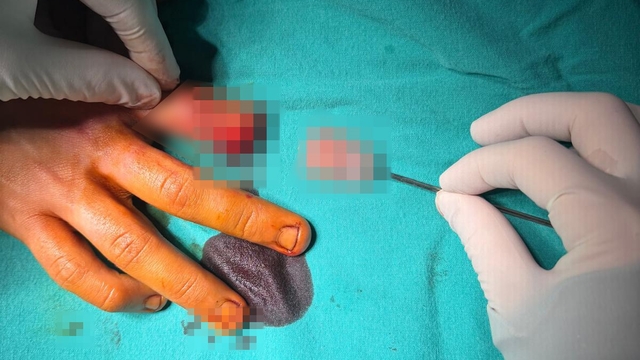 Bandırma'da asansör kazasında kopan parmak başarılı ameliyatla kurtarıldı