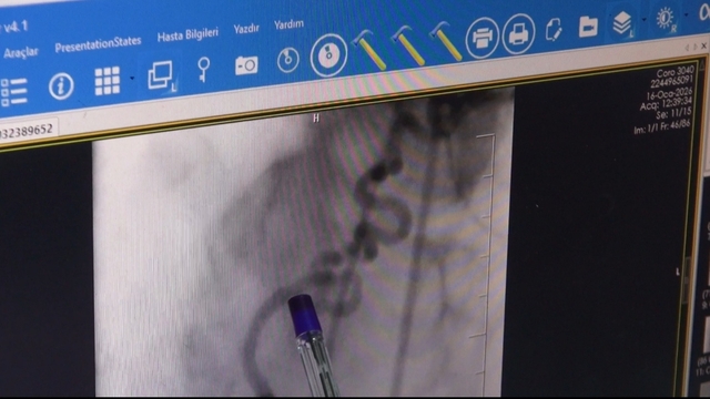 Hastanın kalbine giden kanı akciğere yönlendiren 'anormal damar' operasyonla kapatıldı