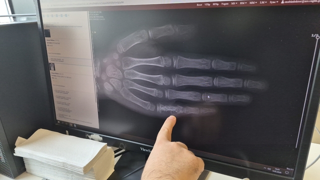 Eskişehir'de her ay 5 ila 7 çocuğa kanser tanısı konuluyor
Çocuk Hematoloji ve Onkoloji Doç. Dr. Ersin Töret:
"Erken tanı yaşamda kalma şansını daha da artırmaktadır"