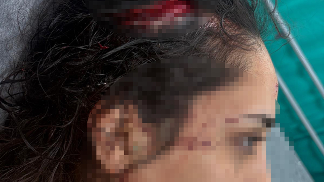 Bakkala giderken sokak köpeklerinin saldırısında yaralandı