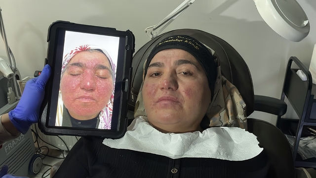 Hastalığı yüzünden yıllarca evden çıkamadı, şimdi ise çekinmeden çıkabiliyor
Bu hastalık yüzünden oğlunun kız isteme merasimi ve düğününe dahi gidemedi, yıllar sonra tedaviyle hayata geri döndü