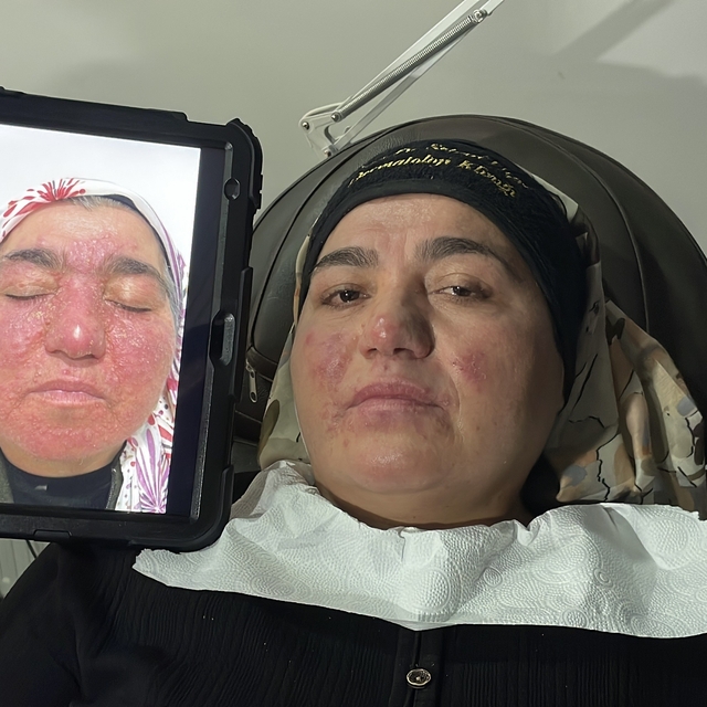 Hastalığı yüzünden yıllarca evden çıkamadı, şimdi ise çekinmeden çıkabiliyo...