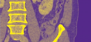 Akciğer damarındaki pıhtıların tanısında radyasyonsuz çözüm