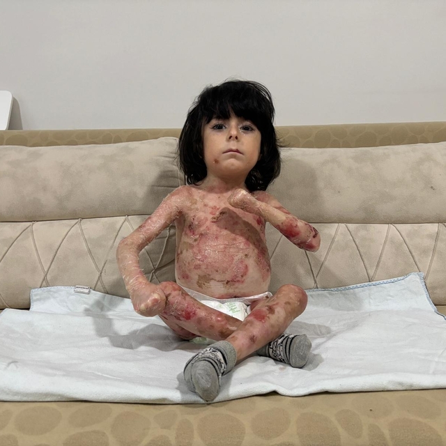 4 yaşındaki İbrahim, 'Kelebek hastalığı' nedeniyle kıyafet giyemiyor