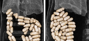 2 şüphelinin midesinden 127 kapsül uyuşturucu çıktı