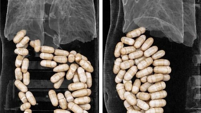 2 şüphelinin midesinden 127 kapsül uyuşturucu çıktı