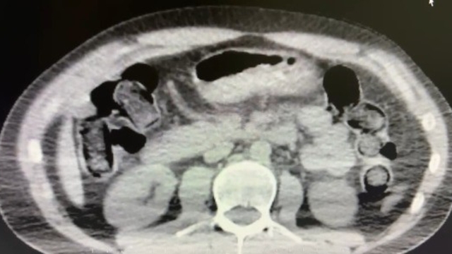 Midelerinde uyuşturucu sevkiyatı yapan 2 torbacı tutuklandı