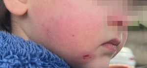 Kreşe bıraktığı çocuğunu darp edilmiş halde aldı 2 yaşındaki çocuk kreşte darp edildi