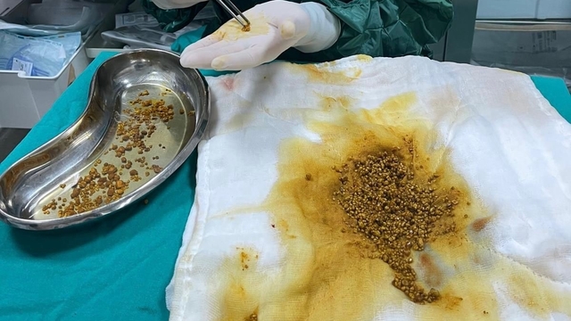 Bingöl'de nadir vaka: Safra kesesinden 2 bin 67 taş çıkarıldı