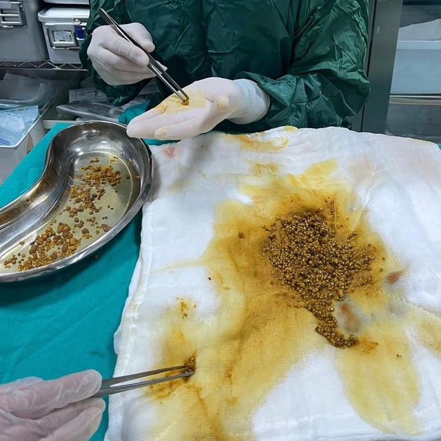 Bingöl'de nadir vaka: Safra kesesinden 2 bin 67 taş çıkarıldı