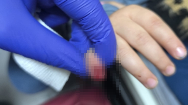 Yürüyen merdivene eli sıkışan çocuğun kopan parmağı kurtarılamadı
