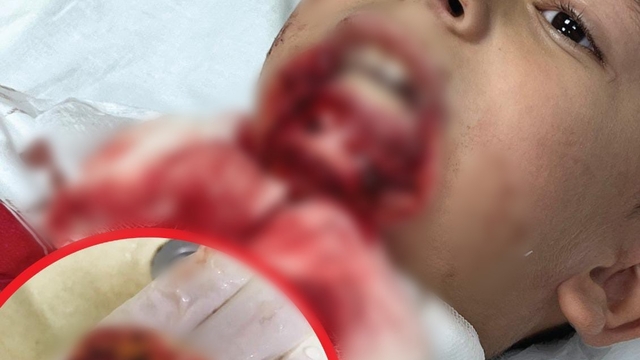 Çanakkale'de demir saplanan çenesi parçalanan öğrencinin davasının 3'üncü duruşması görüldü
Çanakkale'de ihmal yüzünden çenesi parçalanan öğrencinin avukatı Tanay: "İş yeri hekimi ve  güvenliği uzmanlarının uyarıları dikkate alınsa ve resmi deftere kaydedilen iki kayıt okunmuş olup gerekli düzeltmeler yapılmış olsa böyle bir kaza gerçekleşmezdi"