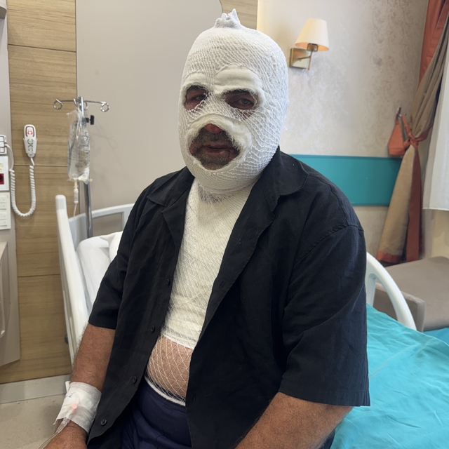 Hararet yapan araca acele müdahale ikinci derece yanığa neden oldu