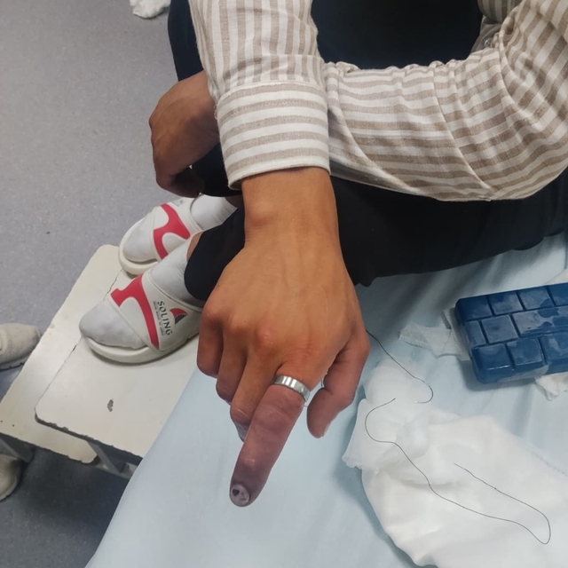 Parmağında sıkışan yüzük itfaiye ekiplerince kesildi