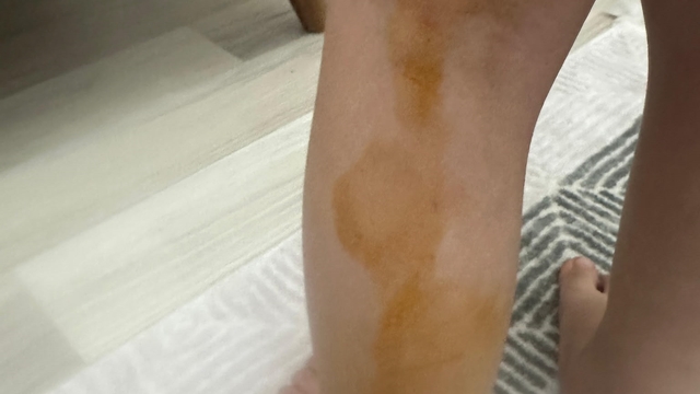 Sokak köpeğinin saldırısına uğrayan Erva yaralandı