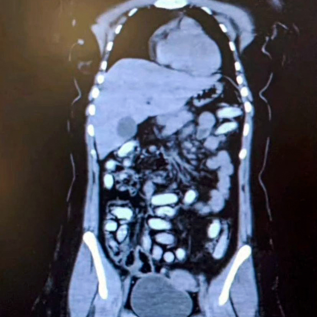 Midesinde 1,5 kilo metamfetaminle yakalanan 2 kadın kurye tutuklandı