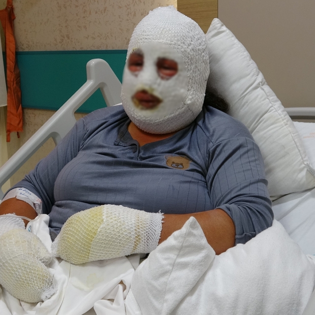 Kızını kurtarmak için alevlerin arasına girdi, kendisi de yandı