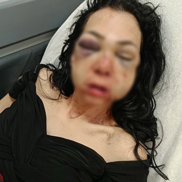 Bayram günü kadının yüzünü bardak ve kül tablasıyla kırmıştı: Tutuklandı